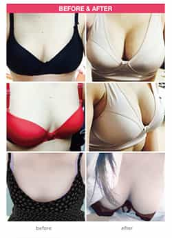 Breast Augmentation, Seoul, South Korea